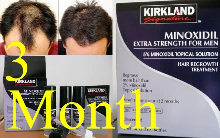 Propecia or minoxidil