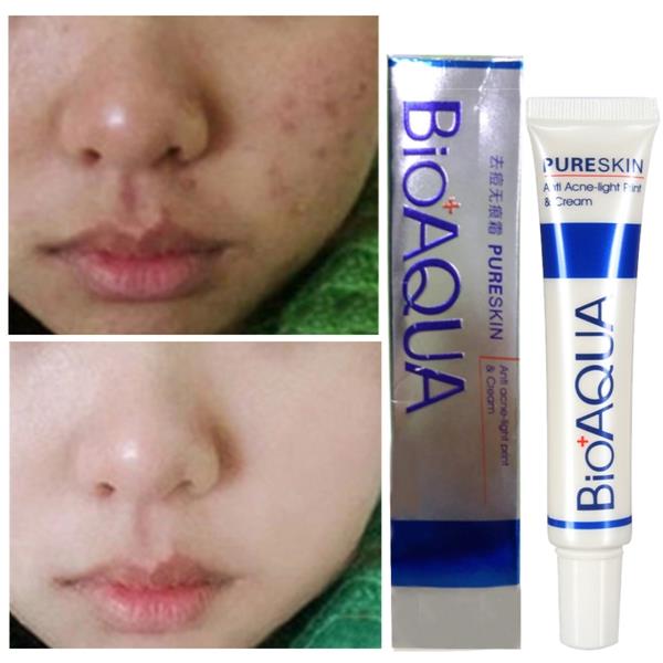 bioaqua acne review
