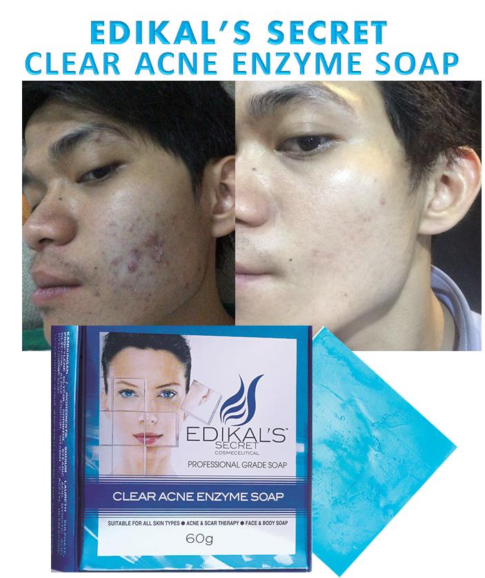 Clear Acne Enzyme Soap by Edikal's Secret with Free Extra Acne Mask Clear Acne Enzyme Soap by Edikal's Secret with Free Extra Acne Mask
