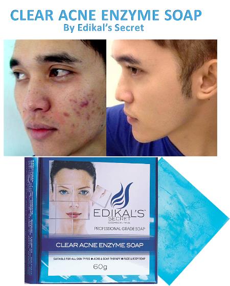 Clear Acne Enzyme Soap by Edikal's Secret with Free Extra Acne Mask Clear Acne Enzyme Soap by Edikal's Secret with Free Extra Acne Mask